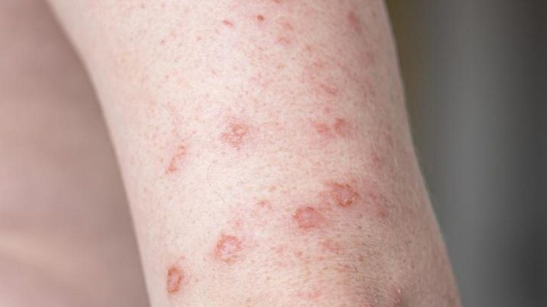 Frengi Belirtileri Nelerdir? Frengi Nasıl Anlaşılır? Tedavi Yöntemleri Nelerdir?